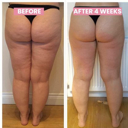 SlimCupp anticellulite cupping apparaat