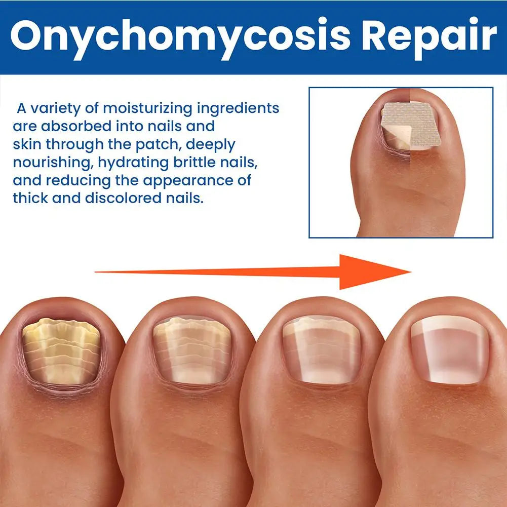HealthyNail schimmelnagel herstelpleisters
