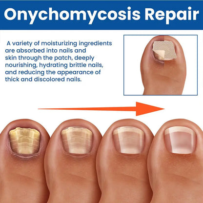 HealthyNail schimmelnagel herstelpleisters