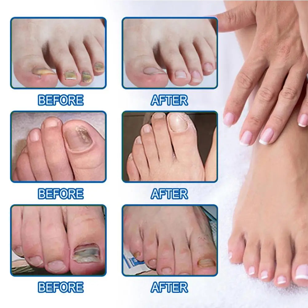 HealthyNail schimmelnagel herstelpleisters