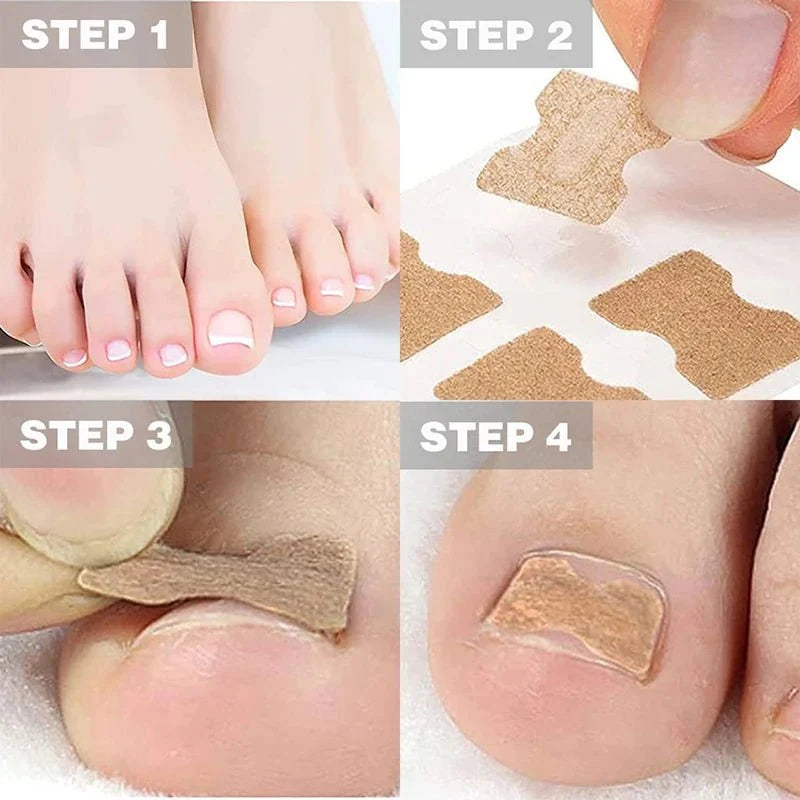 FixaNail zachte nagelcorrectie tegen ingegroeide nagels
