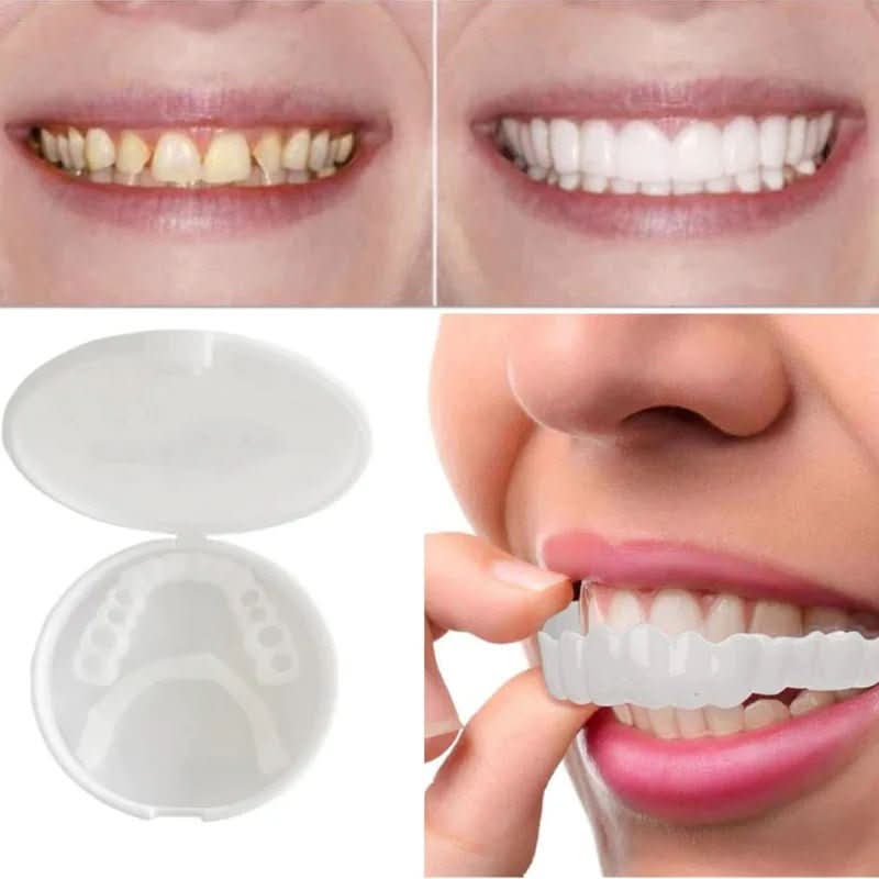 SnapFit Smile tandrestauratie voor een stralende lach