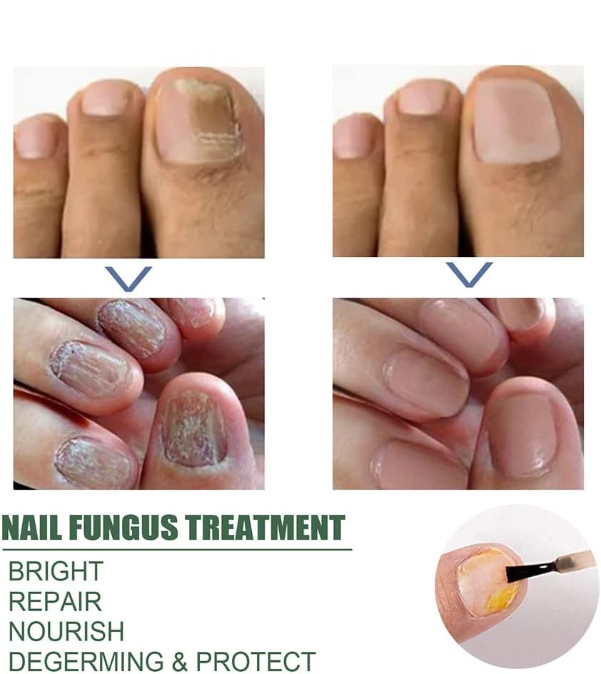 PureNail nagelschimmel behandeling serum