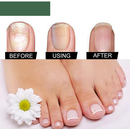 PureNail nagelschimmel behandeling serum